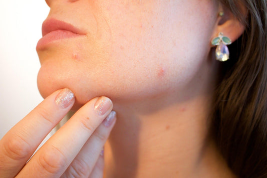 Face Mapping & Hormonal Balance: What Your Skin Might Be Telling You